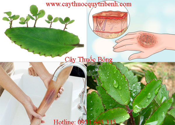 cây thuốc bỏng
