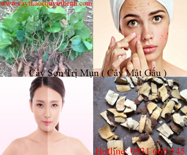 mua-cay-son-tri-mun-chat-luong-tai-tp-hcm